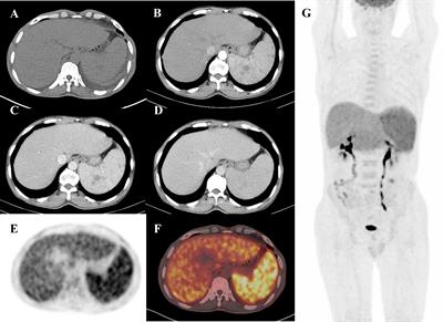 Case Report: FDG-PET/CT findings in co-infection of visceral leishmaniasis and chronic hepatitis B